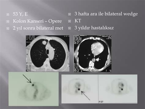 akciğer tümörlerinde humeroskapular periartroz